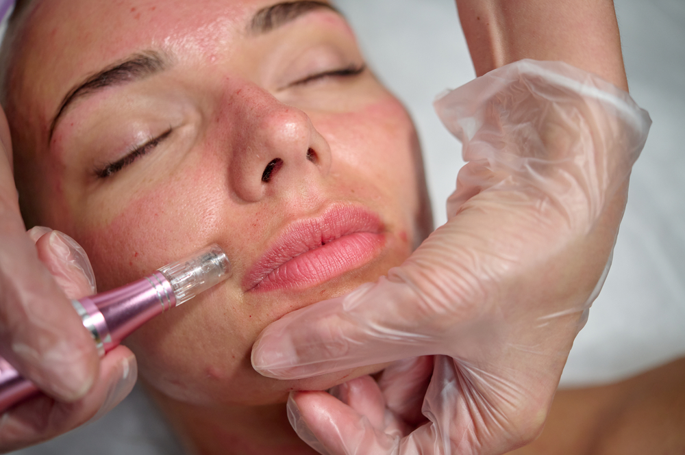 cosmetician-makes-microneedling-care-patient-using-2023438007